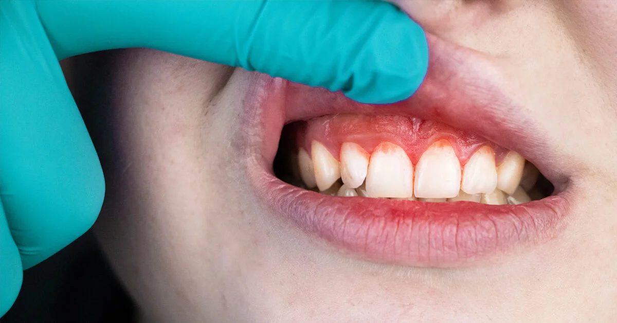 Teeth Gum Surgeries in Dubai Sejovi Dental & Implant Center