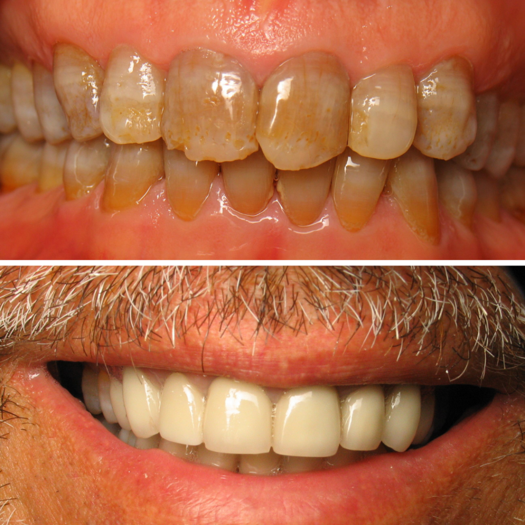 Dental smile transformation in dubai , Best Dental Clinic in dubai