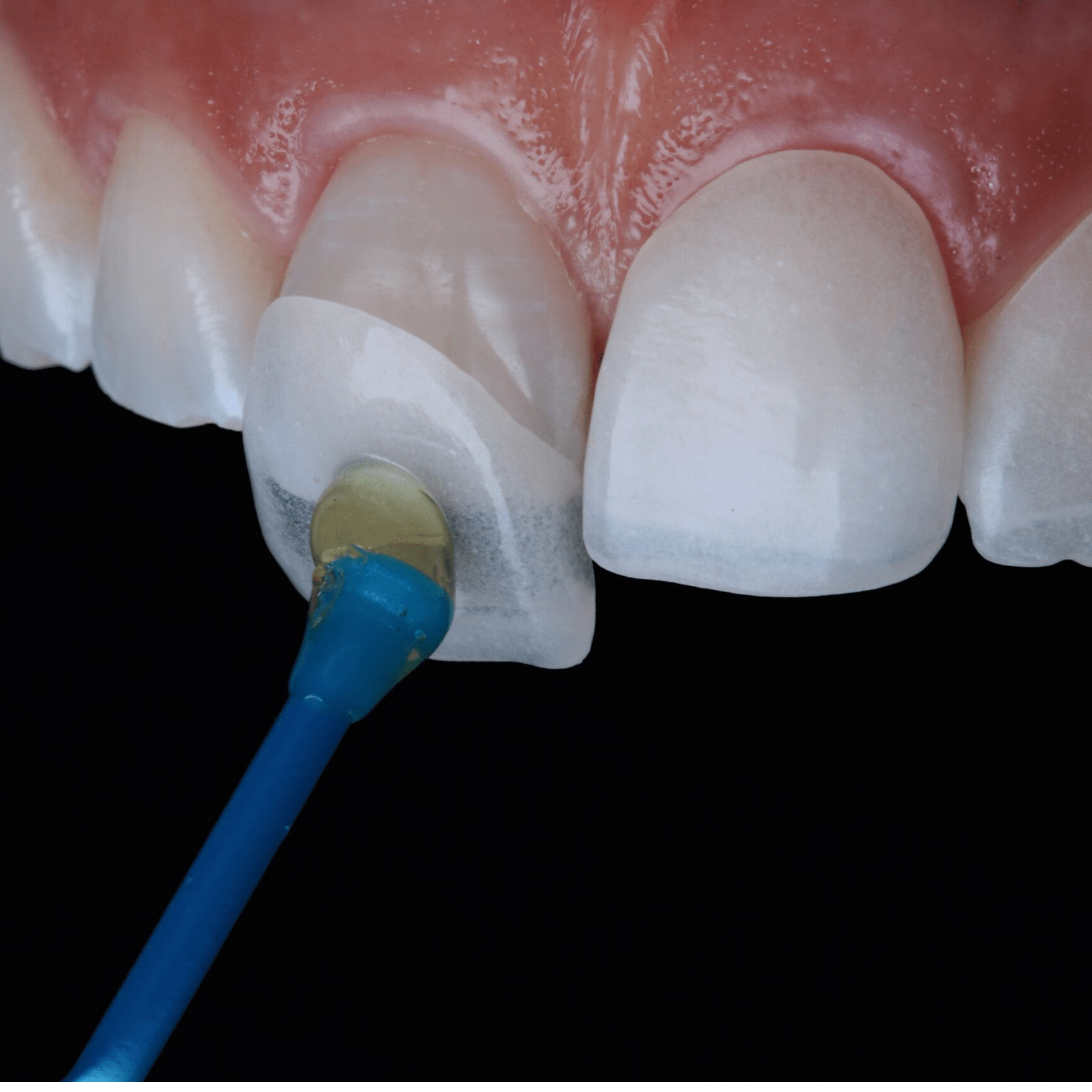 13 Facts about Dental Veneers - Sejovi Dental & Implant Center Dubai