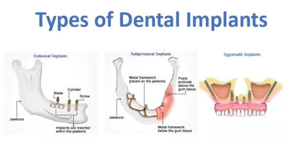 best dental implants dubai