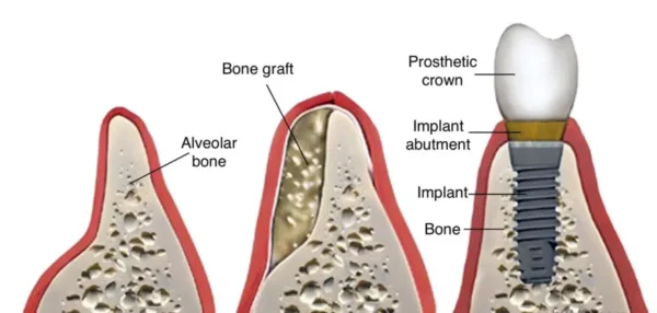 bone graft in dubai for implants