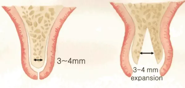 ridge expansion in dubai for implants