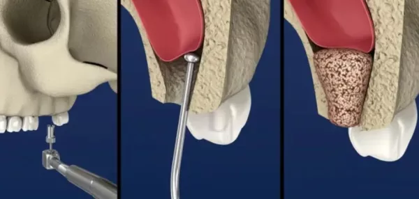 sinus lift in dubai for dental implants