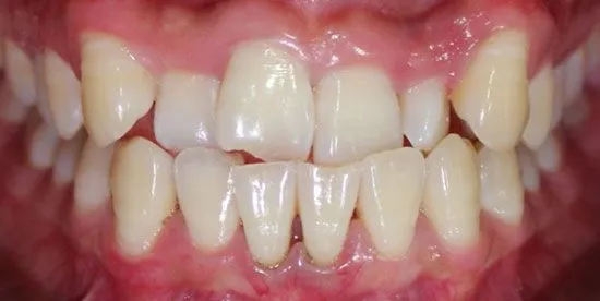 Invisalign before 1 Invisalign before 1