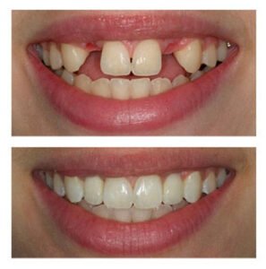 artifical-teeths-in-dubai-297x300-1.jpeg