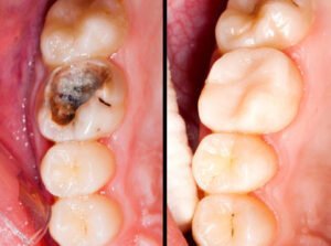 cavity-treatment-in-dubai-300x223-1.jpeg
