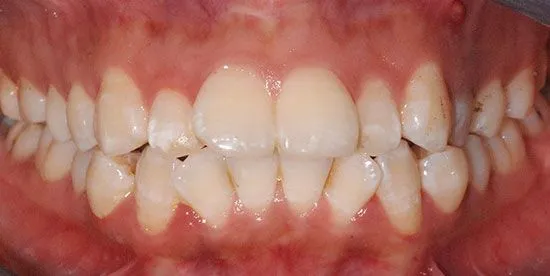 in visalign before-2 in visalign before-2