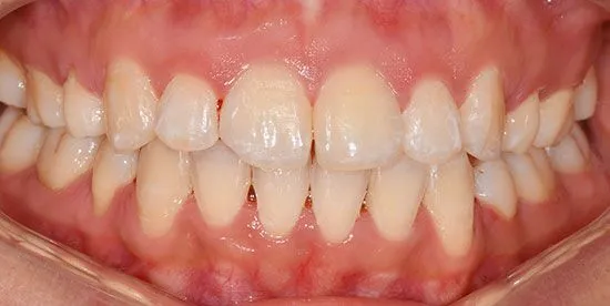 invisalign after 2 invisalign after 2