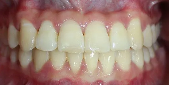 invisalign after 6 invisalign after 6