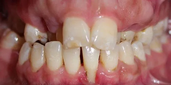 invisalign before 5 invisalign before 5