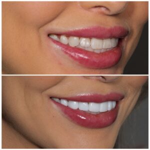 smiling-dental-veneers-dubai-300x300-1.jpeg
