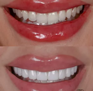 veneers-in-dubai-300x294-1.webp