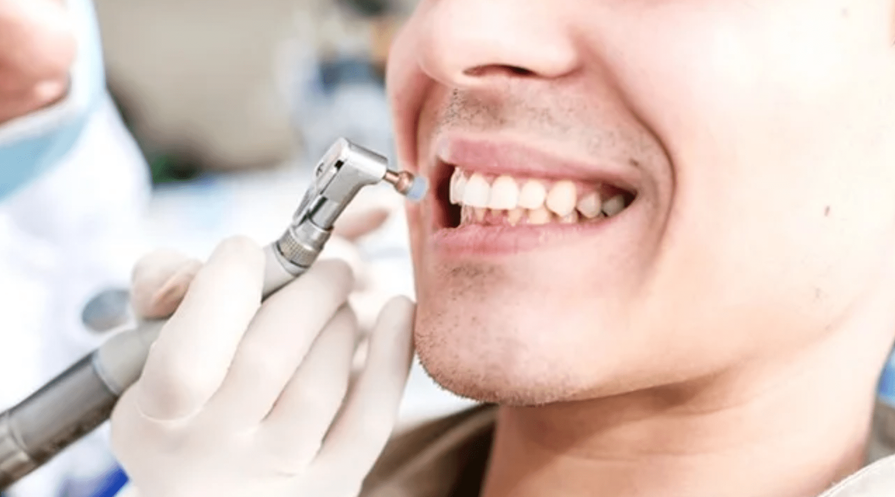 teeth polishing in JLT dubai